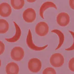 medical microscope comparison showing normal round red blood cells next to abnormal crescent shaped sickled cells