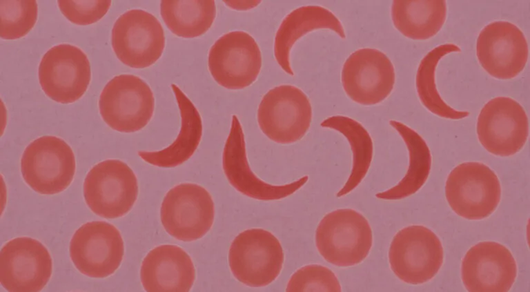 What is Sickle Cell Disease? Causes, Symptoms, and Latest Treatments